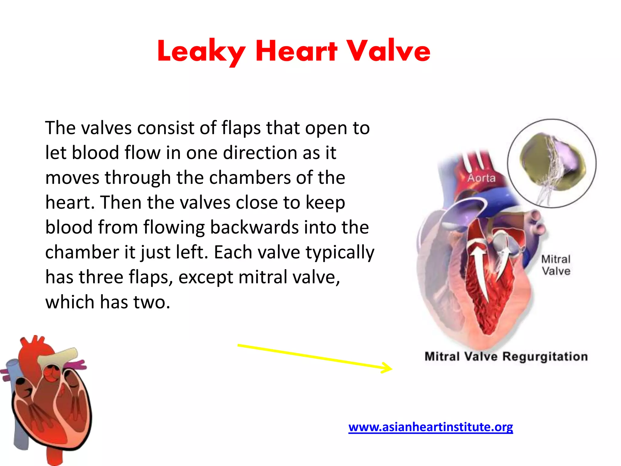 What Is A Leak In The Heart